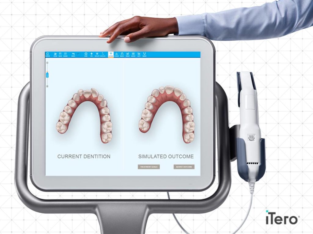 iTero Scanner Haug Orthodontics Alton, IL Highland, IL